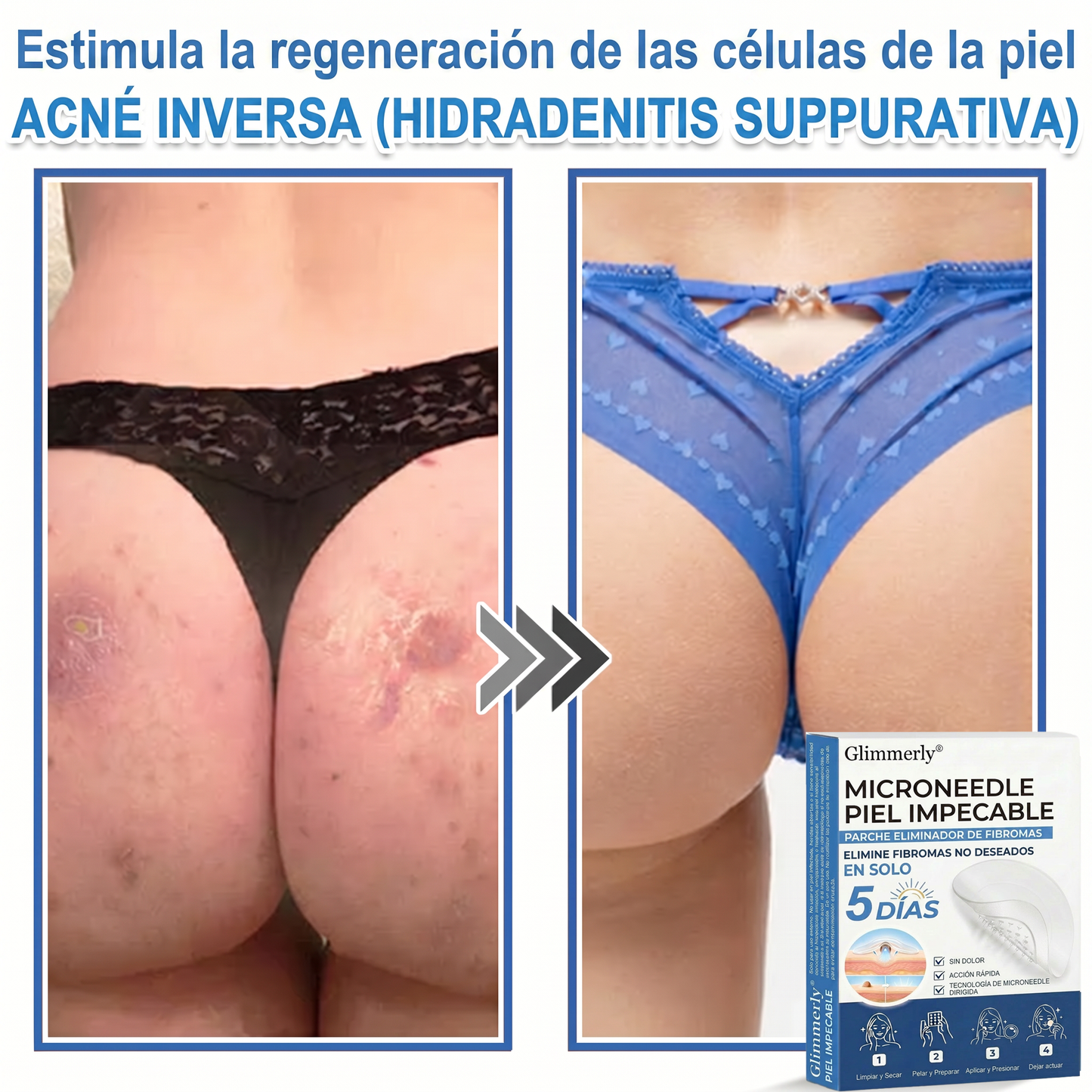 👩‍⚕️ Glimmerly® Parche 2 en 1 de microagujas e hidrocoloide | Eliminador de lunares en relieve, acné, verrugas planas y acrocordones | Mejora arrugas, cicatrices e imperfecciones | Parches invisibles para granos (rostro y cuerpo) | 144 unidades 🎁