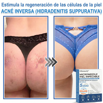 👩‍⚕️ Glimmerly® Parche 2 en 1 de microagujas e hidrocoloide | Eliminador de lunares en relieve, acné, verrugas planas y acrocordones | Mejora arrugas, cicatrices e imperfecciones | Parches invisibles para granos (rostro y cuerpo) | 144 unidades 🎁