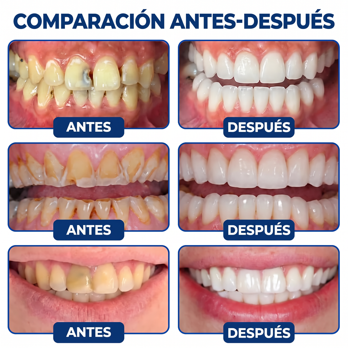 Glimmerly® Sistema DentRestore de reparación y relleno dental💥