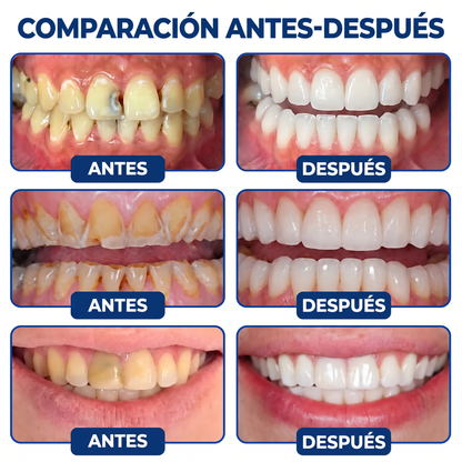 Glimmerly® Sistema DentRestore de reparación y relleno dental💥