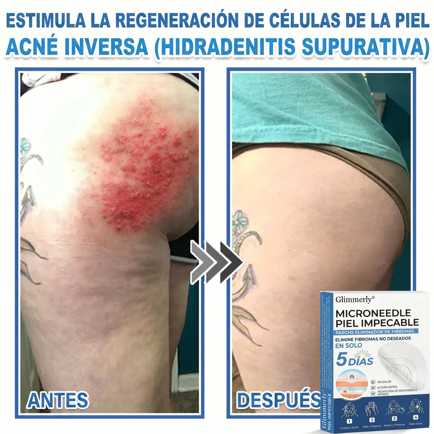 👩‍⚕️ Glimmerly® Parche 2 en 1 de microagujas e hidrocoloide | Eliminador de lunares en relieve, acné, verrugas planas y acrocordones | Mejora arrugas, cicatrices e imperfecciones | Parches invisibles para granos (rostro y cuerpo) | 144 unidades 🎁