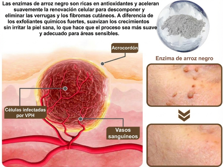 Pureluxo® CremaBlancoCalmante y Regeneradora de Arroz NegroY  (Para el tratamiento de verrugas, crecimientos cutáneos, imperfecciones e hiperpigmentación)