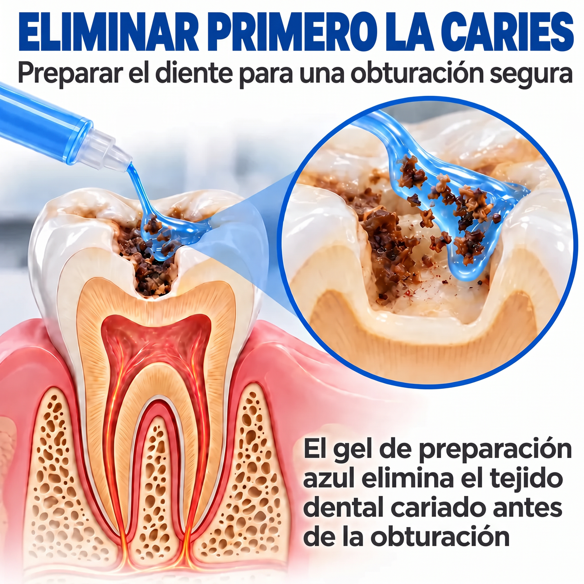 Glimmerly® Sistema DentRestore de reparación y relleno dental💥
