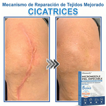 👩‍⚕️ Glimmerly® Parche 2 en 1 de microagujas e hidrocoloide | Eliminador de lunares en relieve, acné, verrugas planas y acrocordones | Mejora arrugas, cicatrices e imperfecciones | Parches invisibles para granos (rostro y cuerpo) | 144 unidades 🎁