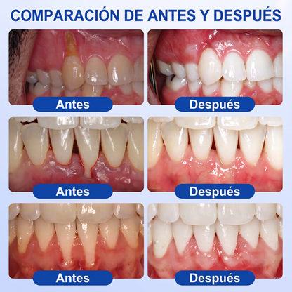 👩‍⚕️🎟️𝑮𝒍𝒊𝒎𝒎𝒆𝒓𝒍𝒚®🦷𝑮𝒖𝒎𝑹𝒆𝒗𝒊𝒗𝒆 𝑮𝒆𝒍 𝒅𝒆 𝑹𝒆𝒑𝒂𝒓𝒂𝒄𝒊ó𝒏 𝑷𝒂𝒓𝒐𝒅𝒐𝒏𝒕𝒂𝒍🎧