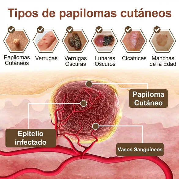 Pureluxo® CremaBlancoCalmante y Regeneradora de Arroz NegroY  (Para el tratamiento de verrugas, crecimientos cutáneos, imperfecciones e hiperpigmentación)