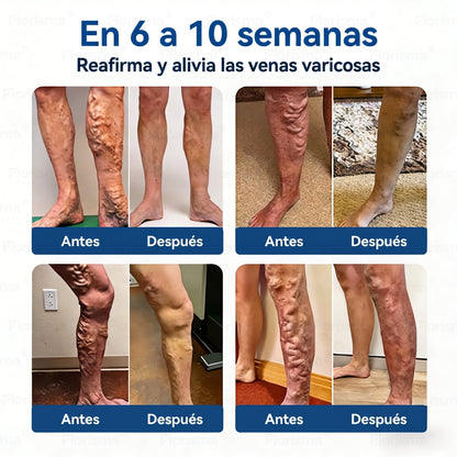 Un parche al día. Alivio visible de las venas en solo 7 días🍃 𝑭𝑳𝑶𝑹𝑰𝑺𝑴𝑨® 𝑫𝑰𝑶𝑺𝑴𝑰𝑵 & 𝑯𝑬𝑺𝑷𝑬𝑹𝑰𝑫𝑰𝑵 𝑪𝒍𝒊𝒏𝒊𝒄𝒂𝒍-𝑮𝒓𝒂𝒅𝒆 𝑭𝒐𝒓𝒎𝒖𝒍𝒂 𝑴𝒊𝒄𝒓𝒐𝒏𝒆𝒆𝒅𝒍𝒆 𝑷𝒂𝒕𝒄𝒉💌