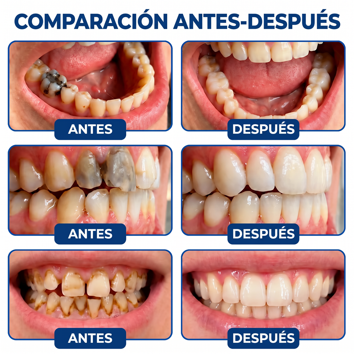 Glimmerly® Sistema DentRestore de reparación y relleno dental💥