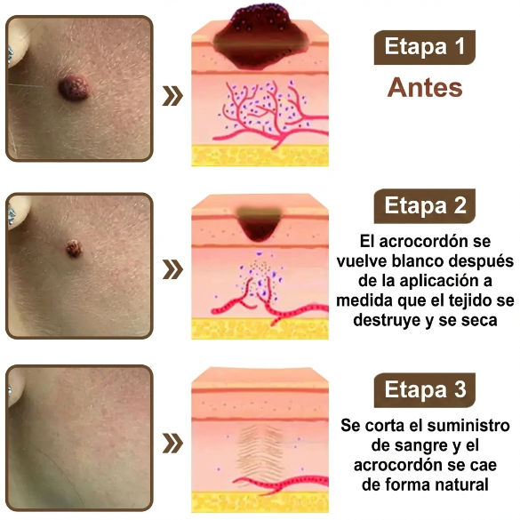 Pureluxo® CremaBlancoCalmante y Regeneradora de Arroz NegroY  (Para el tratamiento de verrugas, crecimientos cutáneos, imperfecciones e hiperpigmentación)