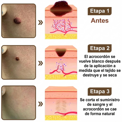 Pureluxo® CremaBlancoCalmante y Regeneradora de Arroz NegroY  (Para el tratamiento de verrugas, crecimientos cutáneos, imperfecciones e hiperpigmentación)