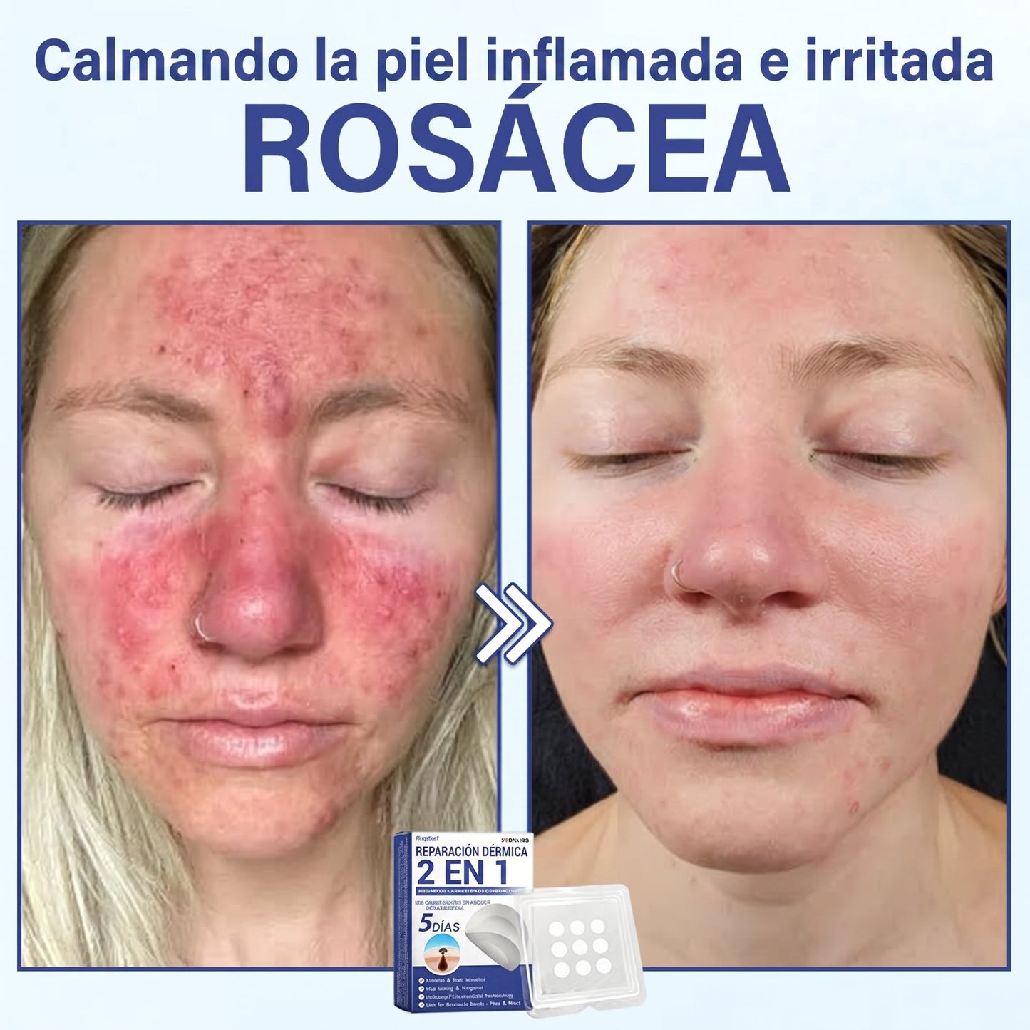 🔥Timilk®DermalRepair Parche de Microagujas y Mancha de Hidrocoloide 2 en 1 💉| Eliminador de lunares elevados, acné, verrugas planas y fibromas cutáneos | Mejora arrugas, cicatrices e imperfecciones | Parches invisibles para granos (rostro y cuerpo)💫