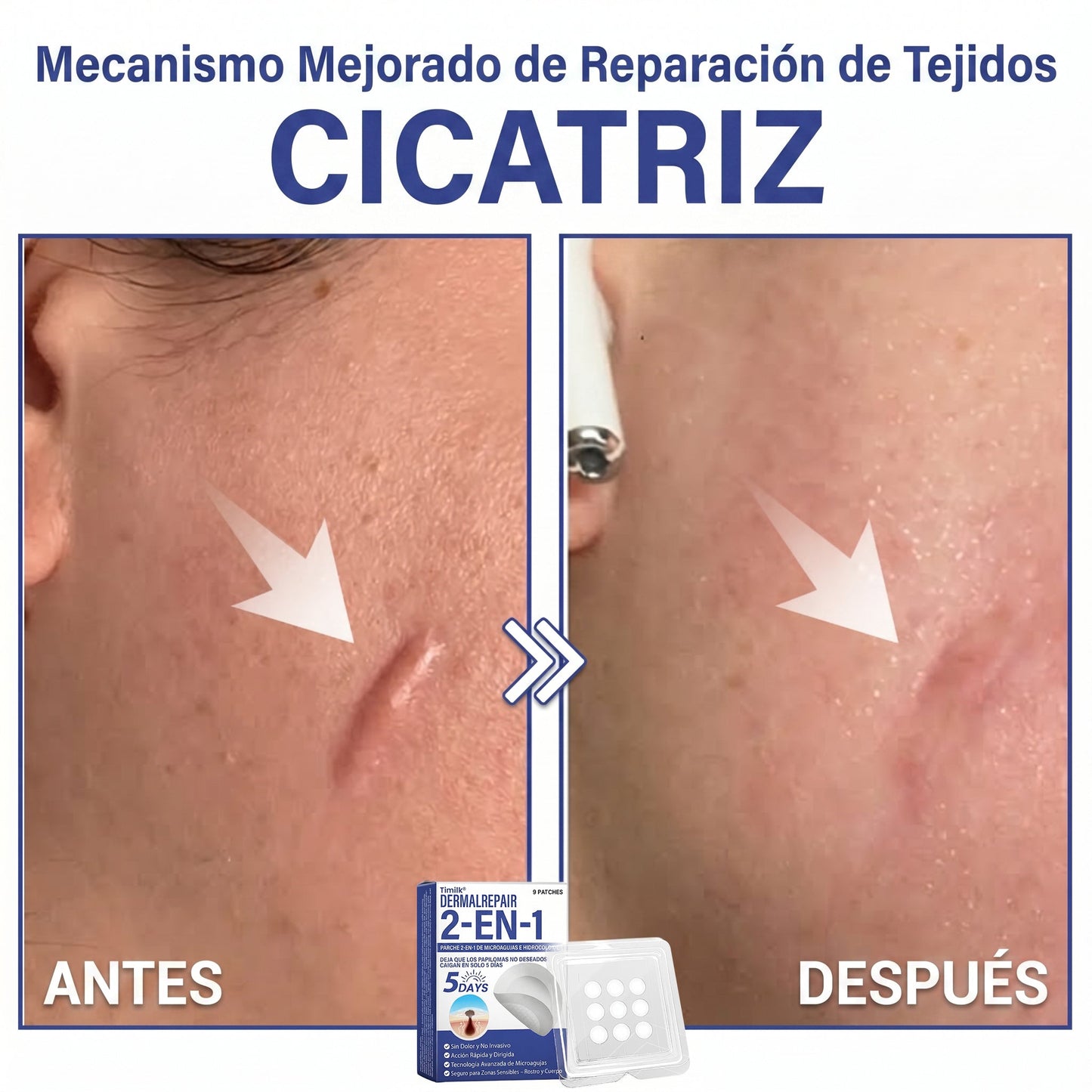 🔥Timilk®DermalRepair Parche de Microagujas y Mancha de Hidrocoloide 2 en 1 💉| Eliminador de lunares elevados, acné, verrugas planas y fibromas cutáneos | Mejora arrugas, cicatrices e imperfecciones | Parches invisibles para granos (rostro y cuerpo)💫