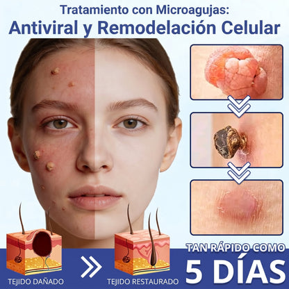 🔥Timilk®DermalRepair Parche de Microagujas y Mancha de Hidrocoloide 2 en 1 💉| Eliminador de lunares elevados, acné, verrugas planas y fibromas cutáneos | Mejora arrugas, cicatrices e imperfecciones | Parches invisibles para granos (rostro y cuerpo)💫