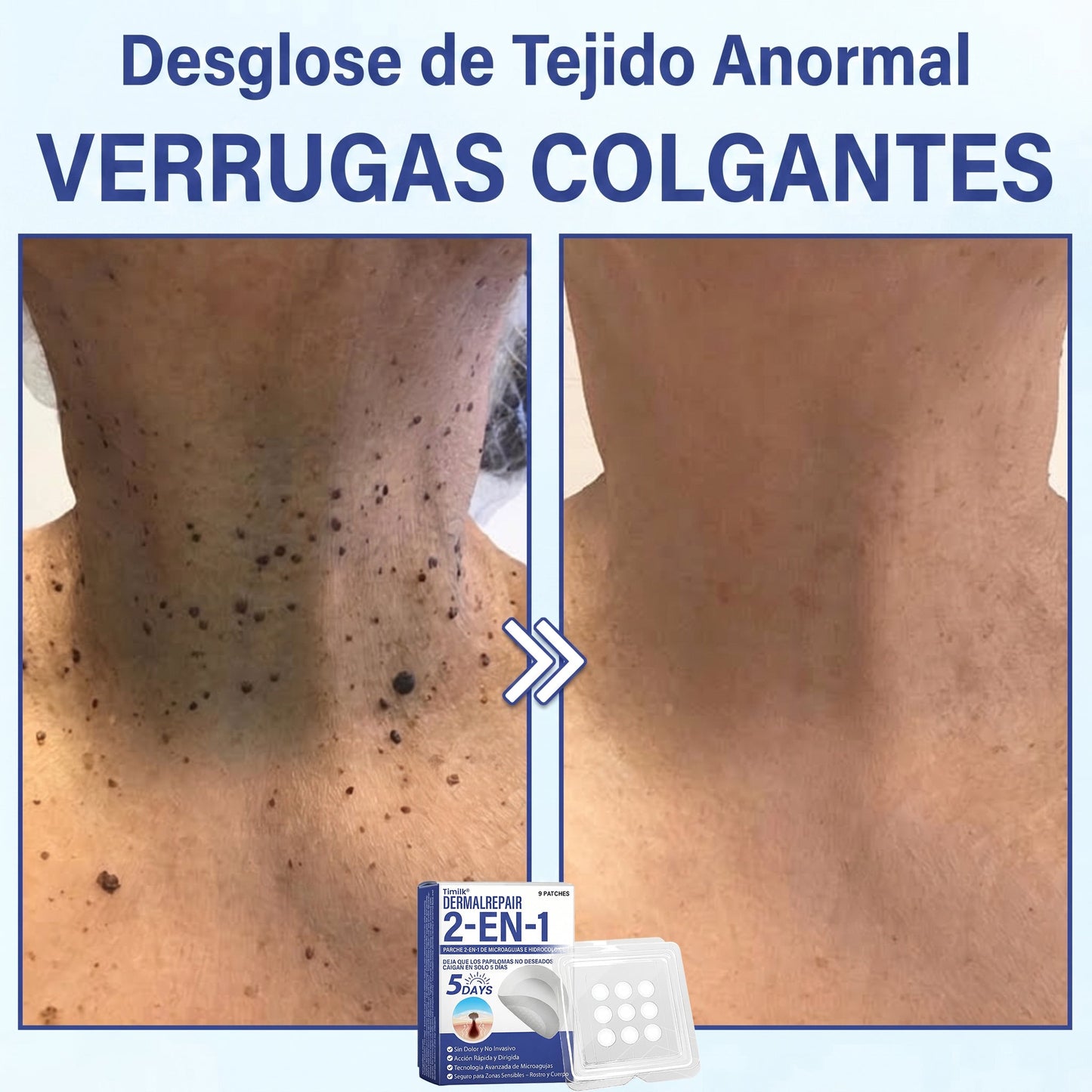 🔥Timilk®DermalRepair Parche de Microagujas y Mancha de Hidrocoloide 2 en 1 💉| Eliminador de lunares elevados, acné, verrugas planas y fibromas cutáneos | Mejora arrugas, cicatrices e imperfecciones | Parches invisibles para granos (rostro y cuerpo)💫