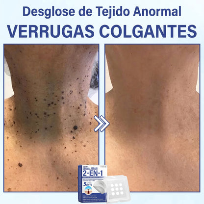 🔥Timilk®DermalRepair Parche de Microagujas y Mancha de Hidrocoloide 2 en 1 💉| Eliminador de lunares elevados, acné, verrugas planas y fibromas cutáneos | Mejora arrugas, cicatrices e imperfecciones | Parches invisibles para granos (rostro y cuerpo)💫