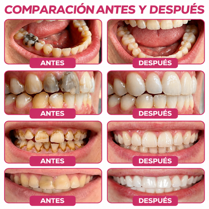 🌿Rolimey® DenPerm – Gel natural de relleno y reparación del esmalte dental para la restauración de caries 🧼