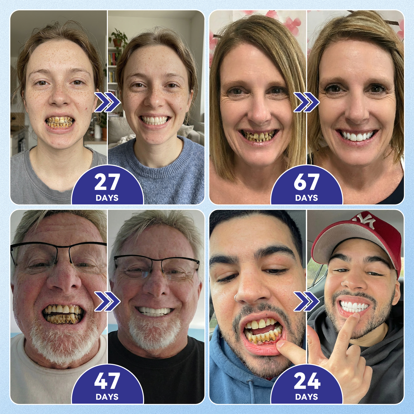 🦷𝐆𝐥𝐢𝐦𝐦𝐞𝐫𝐥𝐲®Parche de microagujas con Tideglusib para la reparación de dientes y encías  3.0