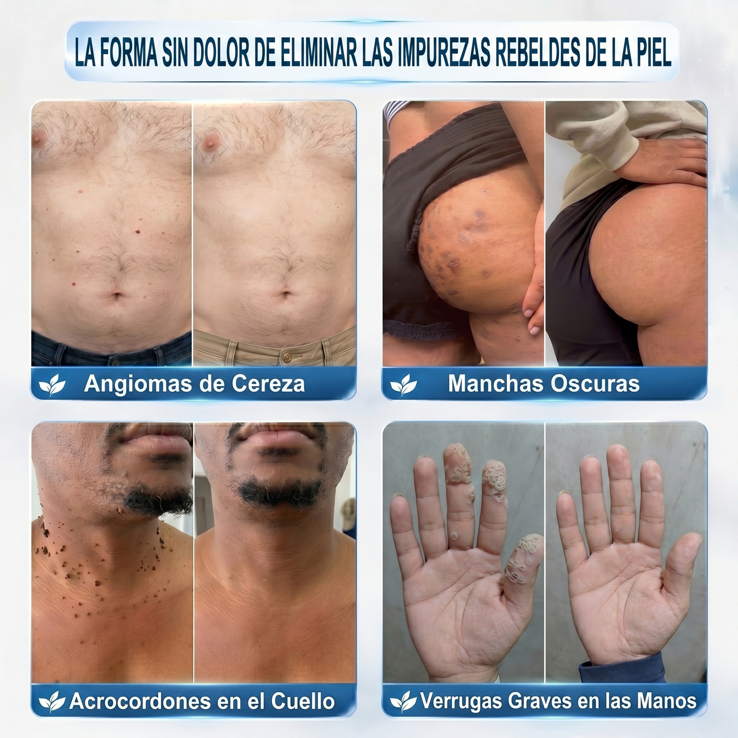 𝐏𝐢𝐜𝐝𝐨® 𝐁𝐨𝐫𝐫𝐚𝐝𝐨𝐫 𝐝𝐞 𝐕𝐞𝐫𝐫𝐮𝐠𝐚𝐬 𝐲 𝐌𝐚𝐧𝐜𝐡𝐚𝐬 𝐝𝐞 𝟕 𝐃í𝐚𝐬(Aplicador roll-on: sin dolor ni cicatrices)🐾