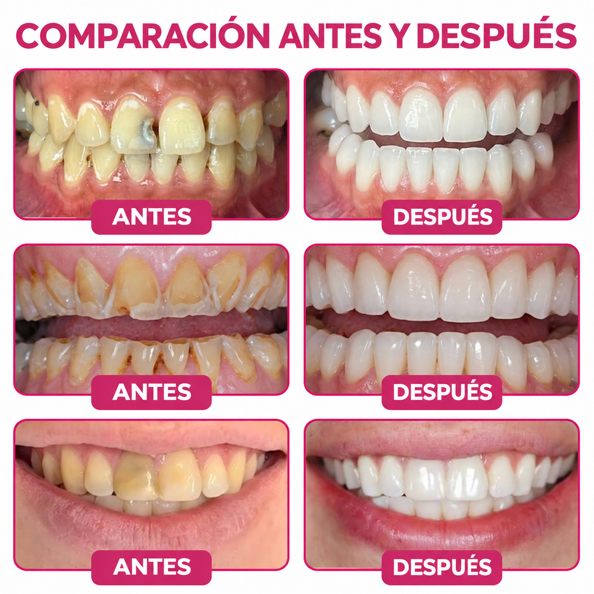 🌿Rolimey® DenPerm – Gel natural de relleno y reparación del esmalte dental para la restauración de caries 🧼