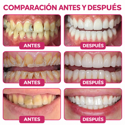 🌿Rolimey® DenPerm – Gel natural de relleno y reparación del esmalte dental para la restauración de caries 🧼