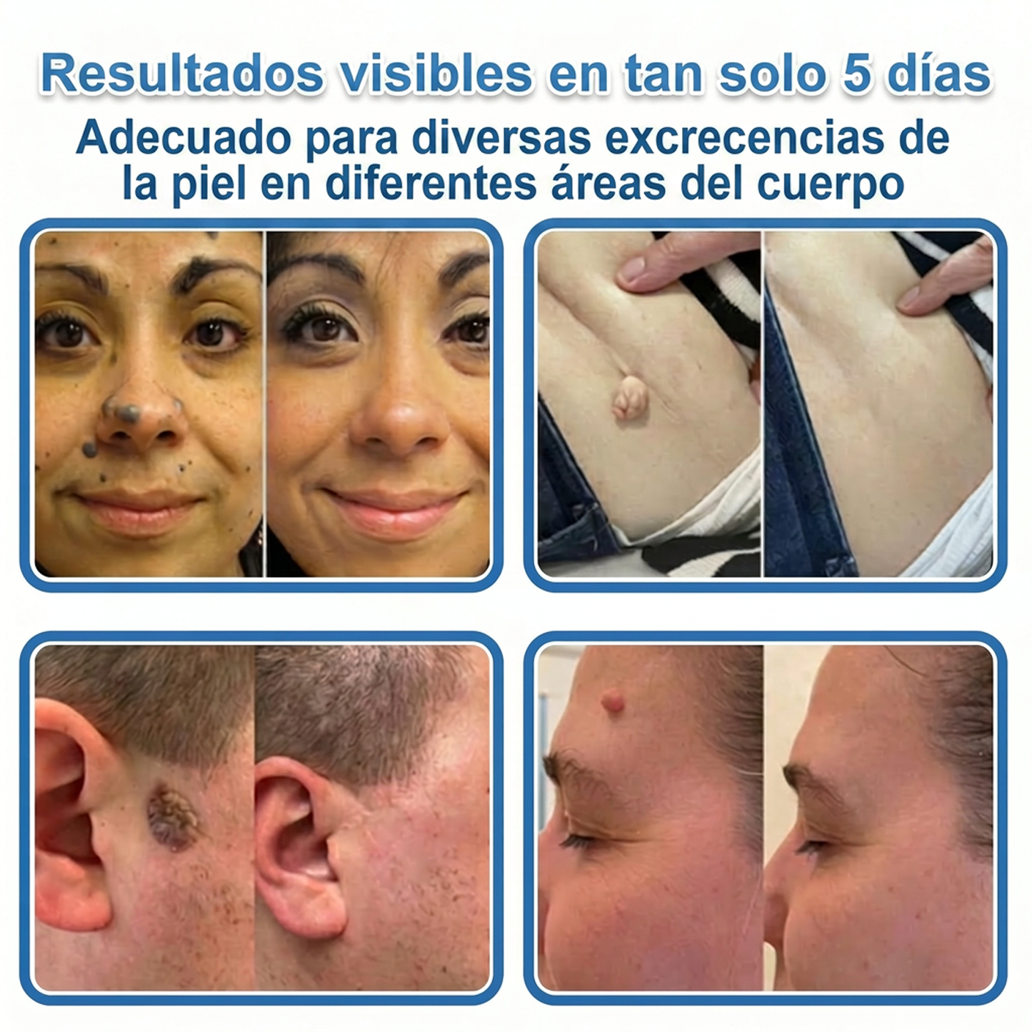 👩‍⚕️ Glimmerly® Parche 2 en 1 de microagujas e hidrocoloide | Eliminador de lunares en relieve, acné, verrugas planas y acrocordones | Mejora arrugas, cicatrices e imperfecciones | Parches invisibles para granos (rostro y cuerpo) | 144 unidades 🎁