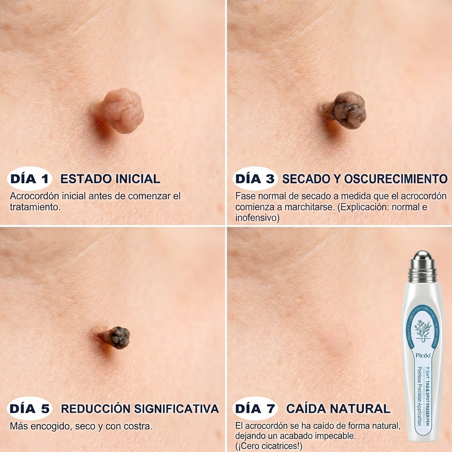 𝐏𝐢𝐜𝐝𝐨® 𝐁𝐨𝐫𝐫𝐚𝐝𝐨𝐫 𝐝𝐞 𝐕𝐞𝐫𝐫𝐮𝐠𝐚𝐬 𝐲 𝐌𝐚𝐧𝐜𝐡𝐚𝐬 𝐝𝐞 𝟕 𝐃í𝐚𝐬(Aplicador roll-on: sin dolor ni cicatrices)🐾