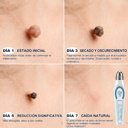 𝐏𝐢𝐜𝐝𝐨® 𝐁𝐨𝐫𝐫𝐚𝐝𝐨𝐫 𝐝𝐞 𝐕𝐞𝐫𝐫𝐮𝐠𝐚𝐬 𝐲 𝐌𝐚𝐧𝐜𝐡𝐚𝐬 𝐝𝐞 𝟕 𝐃í𝐚𝐬(Aplicador roll-on: sin dolor ni cicatrices)🐾