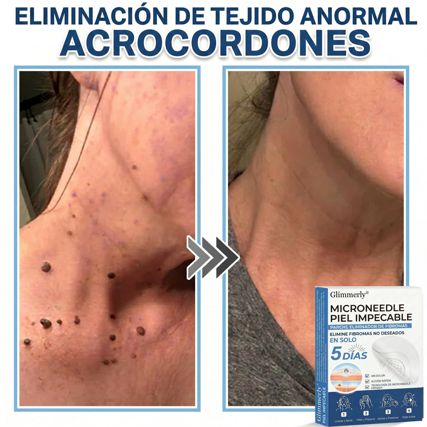 👩‍⚕️ Glimmerly® Parche 2 en 1 de microagujas e hidrocoloide | Eliminador de lunares en relieve, acné, verrugas planas y acrocordones | Mejora arrugas, cicatrices e imperfecciones | Parches invisibles para granos (rostro y cuerpo) | 144 unidades 🎁