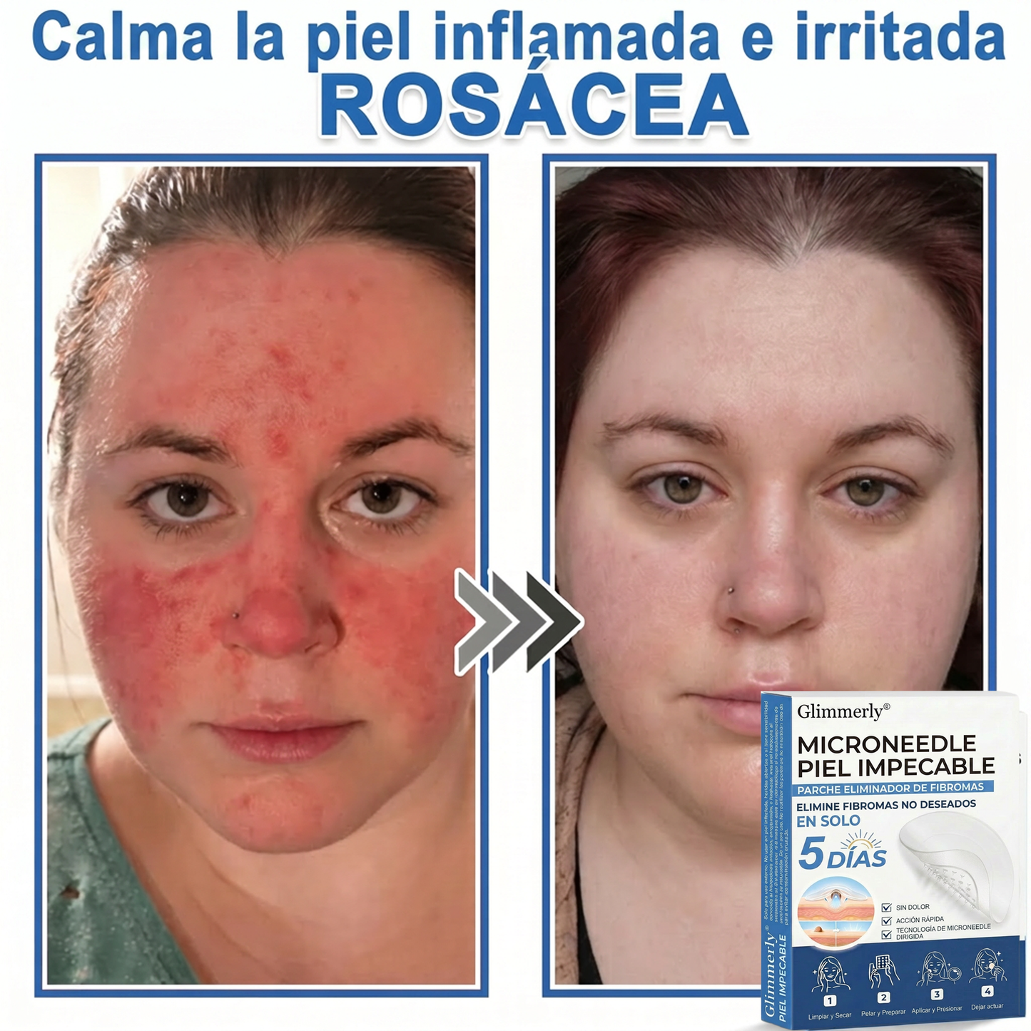 👩‍⚕️ Glimmerly® Parche 2 en 1 de microagujas e hidrocoloide | Eliminador de lunares en relieve, acné, verrugas planas y acrocordones | Mejora arrugas, cicatrices e imperfecciones | Parches invisibles para granos (rostro y cuerpo) | 144 unidades 🎁