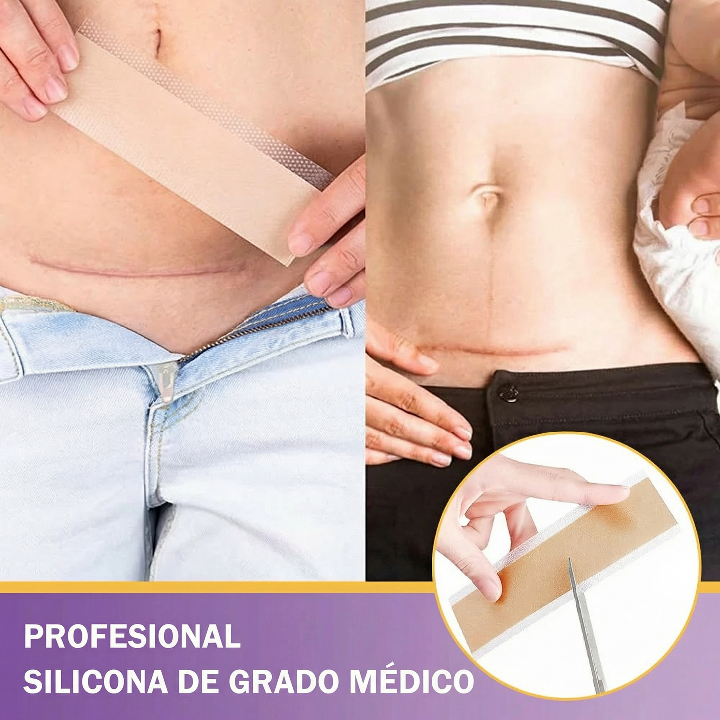 ✅Tienda oficial |BBOJI®ÁCIDO HIALURÓNICO CINTA DE REPARACIÓN DE NANO MICROMUJAS 🏥(Tratamiento de cicatrices antiguas y recientes, reducción de cicatrices quirúrgicas, estrías, queloides, acné, quemaduras, verrugas, dermatomas y varices)