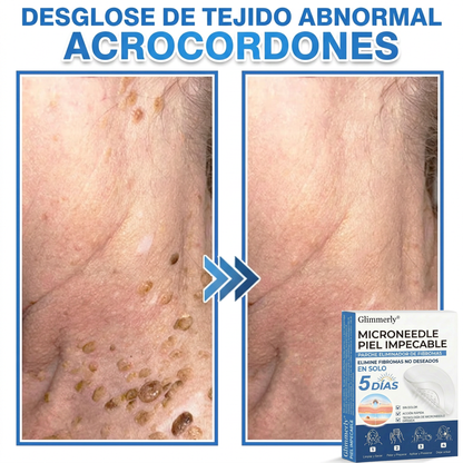 👩‍⚕️ Glimmerly® Parche 2 en 1 de microagujas e hidrocoloide | Eliminador de lunares en relieve, acné, verrugas planas y acrocordones | Mejora arrugas, cicatrices e imperfecciones | Parches invisibles para granos (rostro y cuerpo) | 144 unidades 🎁