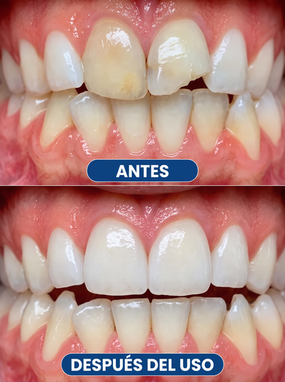 Glimmerly® Sistema DentRestore de reparación y relleno dental💥
