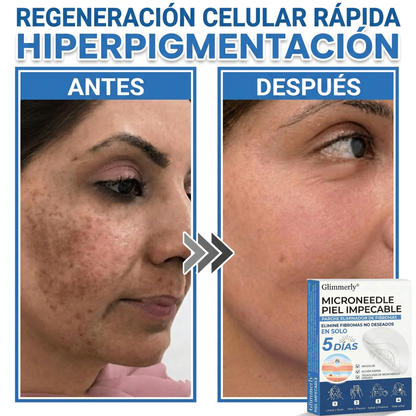 👩‍⚕️ Glimmerly® Parche 2 en 1 de microagujas e hidrocoloide | Eliminador de lunares en relieve, acné, verrugas planas y acrocordones | Mejora arrugas, cicatrices e imperfecciones | Parches invisibles para granos (rostro y cuerpo) | 144 unidades 🎁