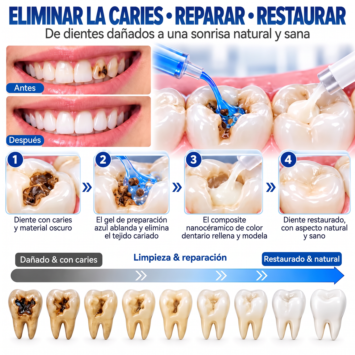 Glimmerly® Sistema DentRestore de reparación y relleno dental💥