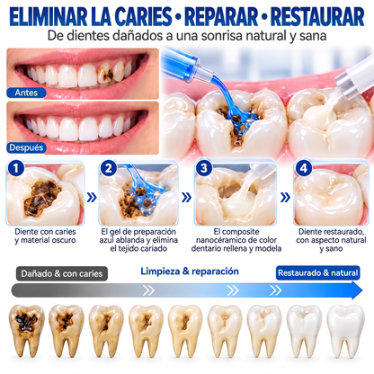 Glimmerly® Sistema DentRestore de reparación y relleno dental💥