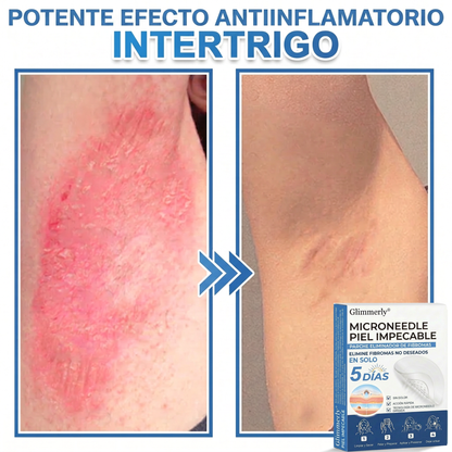 👩‍⚕️ Glimmerly® Parche 2 en 1 de microagujas e hidrocoloide | Eliminador de lunares en relieve, acné, verrugas planas y acrocordones | Mejora arrugas, cicatrices e imperfecciones | Parches invisibles para granos (rostro y cuerpo) | 144 unidades 🎁